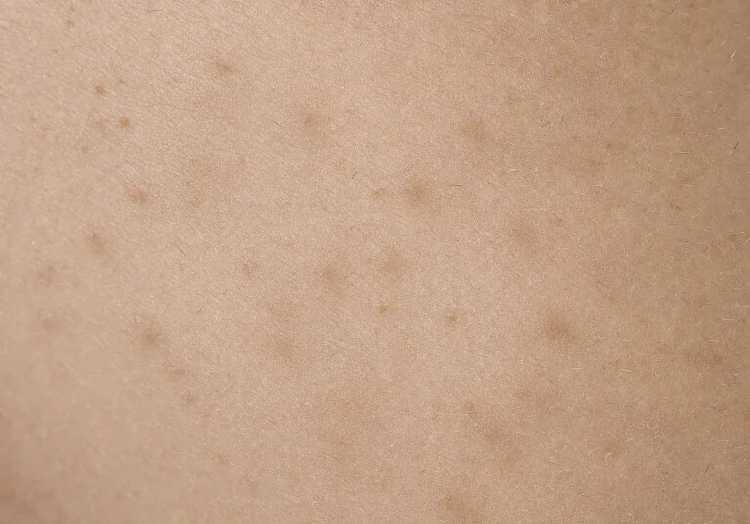 La stessa zona senza nuovi bozzi, con il taglio a filo pelle