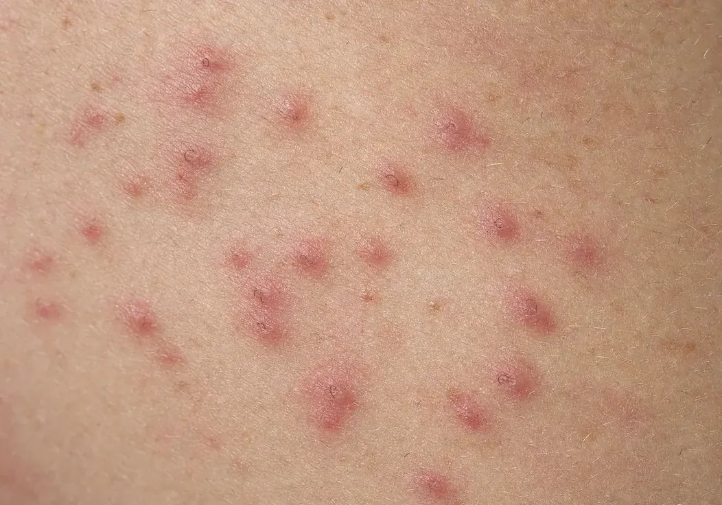 Entzündete Beulen auf der Haut nach einer zu gründlichen Rasur